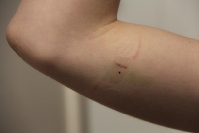 implanon removal scar.jpg